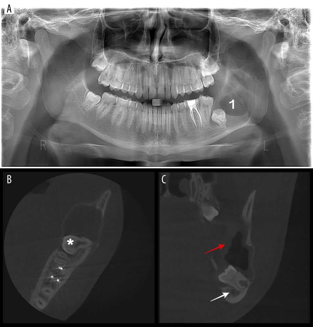Preoperative radiological examination. (A) Orthopantomography examination (“1” indicates the cyst). (B) Cone bean computed tomography (CBCT) axial view illustrating the ballooned buccal and lingual plates and the buccal-lingual orientation of the impacted tooth (* indicates the crown of the tooth). (C) CBCT coronal view illustrating the displaced inferior alveolar nerve and the relationship between the tooth and the mandibular canal (white arrow indicates the mandibular canal and red arrow indicates the 8 mm-thick cystic membrane).