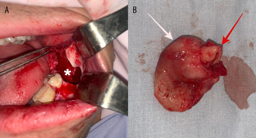 Clinical and paraclinical view of the tumor. (A) Intraoperative view after cyst removal (* indicates the remnant osseous geode). (B) Specimen of excision (white arrow indicates the cystic membrane and red arrow indicates the roots of the 3.8 tooth).