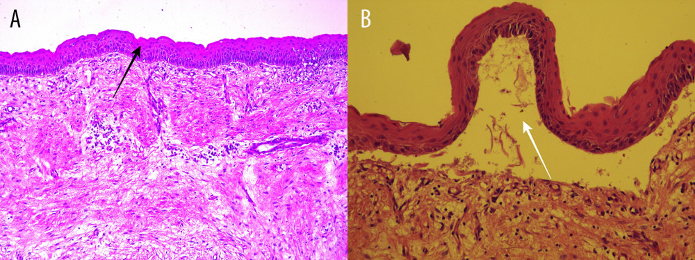 Histopathological examination. (A) The fibrous wall with stratified squamous epithelium, focal parakeratosis, and ulceration (black arrow indicates the stratified squamous epithelium). (B) Epithelium under higher magnification (white arrow indicates the separation of the epithelium from the underlying connective tissue).