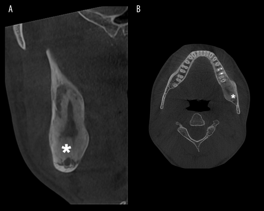 Postoperative cone beam computed tomography examination at the 6-month follow-up. (A) Cross-section view (* indicates the new bone deposition). (B) Axial view (* indicates the new bone deposition).