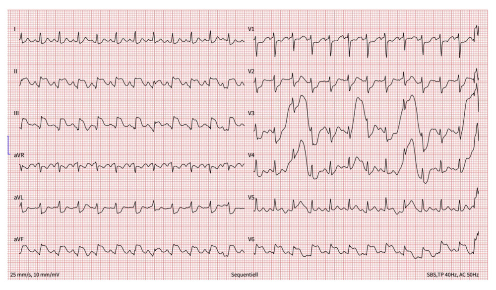 The 12-lead electrocardiogram after cardiac arrest: Marked ST-elevation in II, III, aVF, and V6 is visible, representing ST-elevation myocardial infarction.