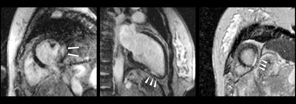 Cardiac magnetic resonance image at 3-month follow-up: Late gadolinium enhancement depicts myocardial scars in 2 separate areas: mid inferolateral (25×22 mm, arrows) and apical inferior (31×27 mm, arrow heads).