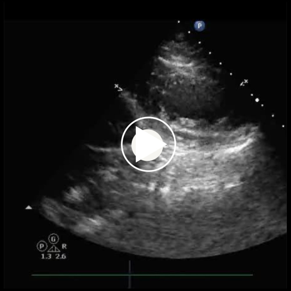 Transthoracic echocardiogram after cardiac arrest: Parasternal short-axis view showing inferior hypo- to akinesia of the left ventricle.