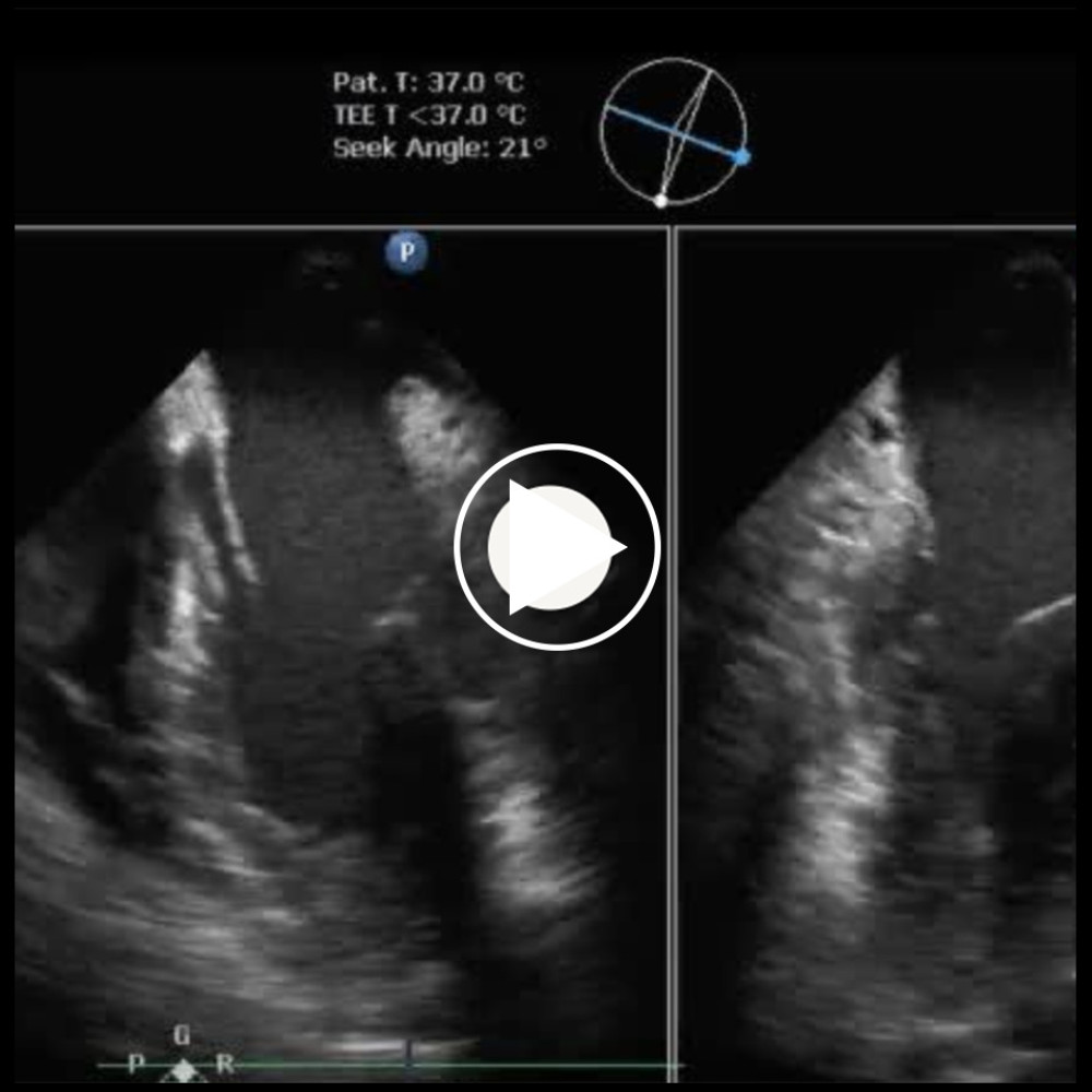 Transesophageal echocardiogram after cardiac arrest showing 4- and 2-chamber view with hypokinesia to akinesia in the basal and mid-inferior and inferolateral segments of the left ventricle.