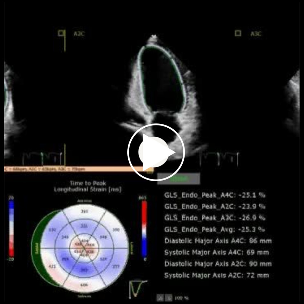 Patient 2. Echocardiography shows severe hypokinesia of the left