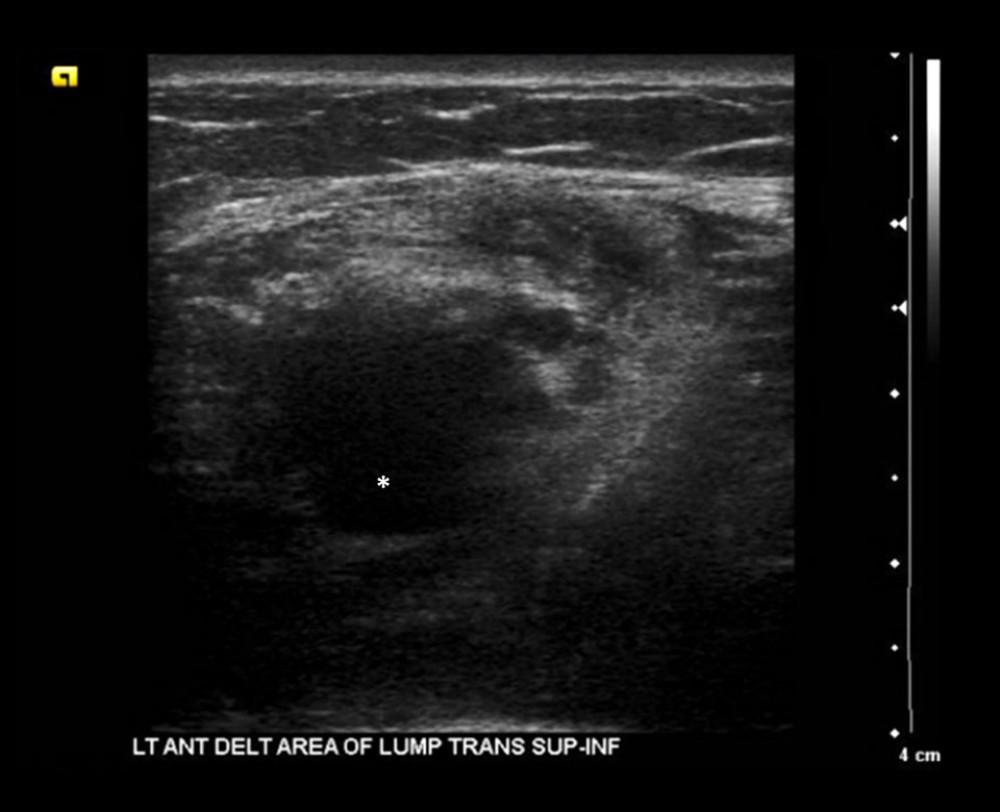 Ultrasound of the left shoulder showing a hypoechoic 23×32×21 mm collection in the left anterior deltoid area. Hematoma indicated by asterisk *.
