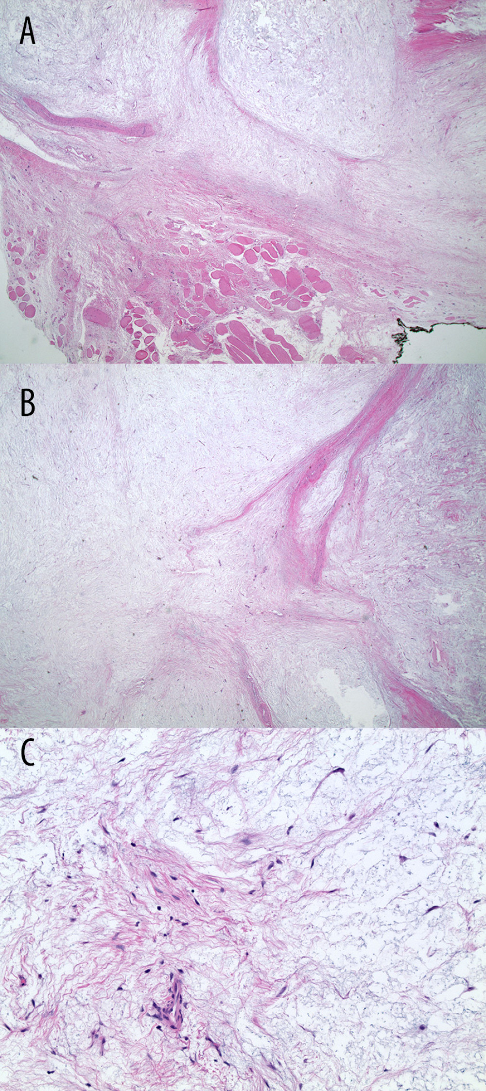 Histopathology slides of biopsied left deltoid muscle mass. (A) Entrapped skeletal muscle fibers at the periphery of the tumor (lower half represents the skeletal muscle fibers which are splayed by the tumor cells). (B) The tumor is a hypocellular lesion composed of bland cells in a background of abundant extracellular myxoid stroma. (C) Small capillary-sized vessels are seen. Necrosis and mitotic figures are not identified. Uniform spindle-to-stellate-shaped cells with uniform oval nuclei and indistinct eosinophilic cytoplasm are noted.
