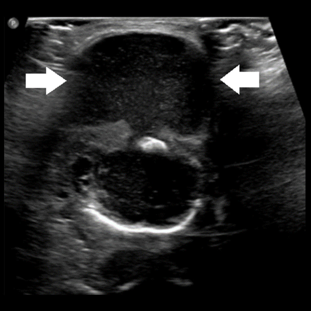 Midline ultrasound neck transverse view of neck mass (between arrows).