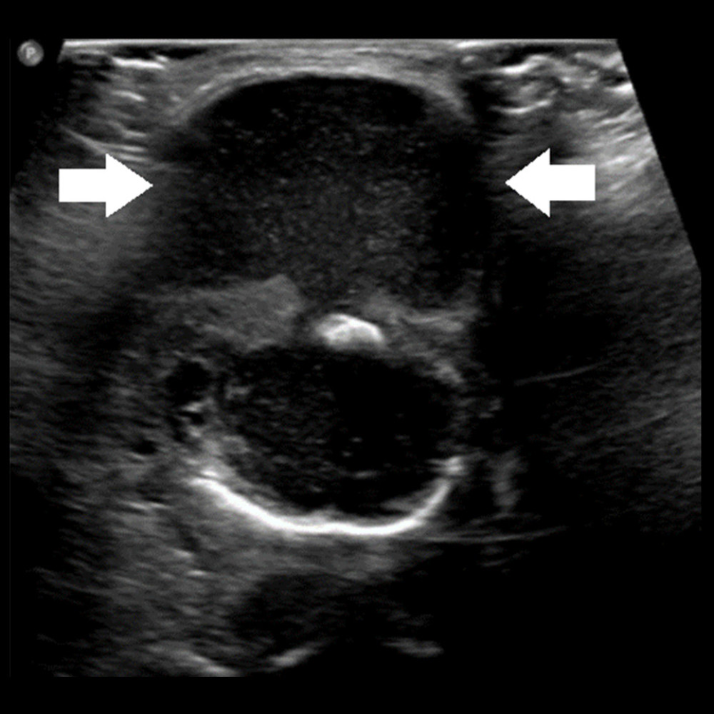 Thyroglossal Duct Cyst Ultrasound