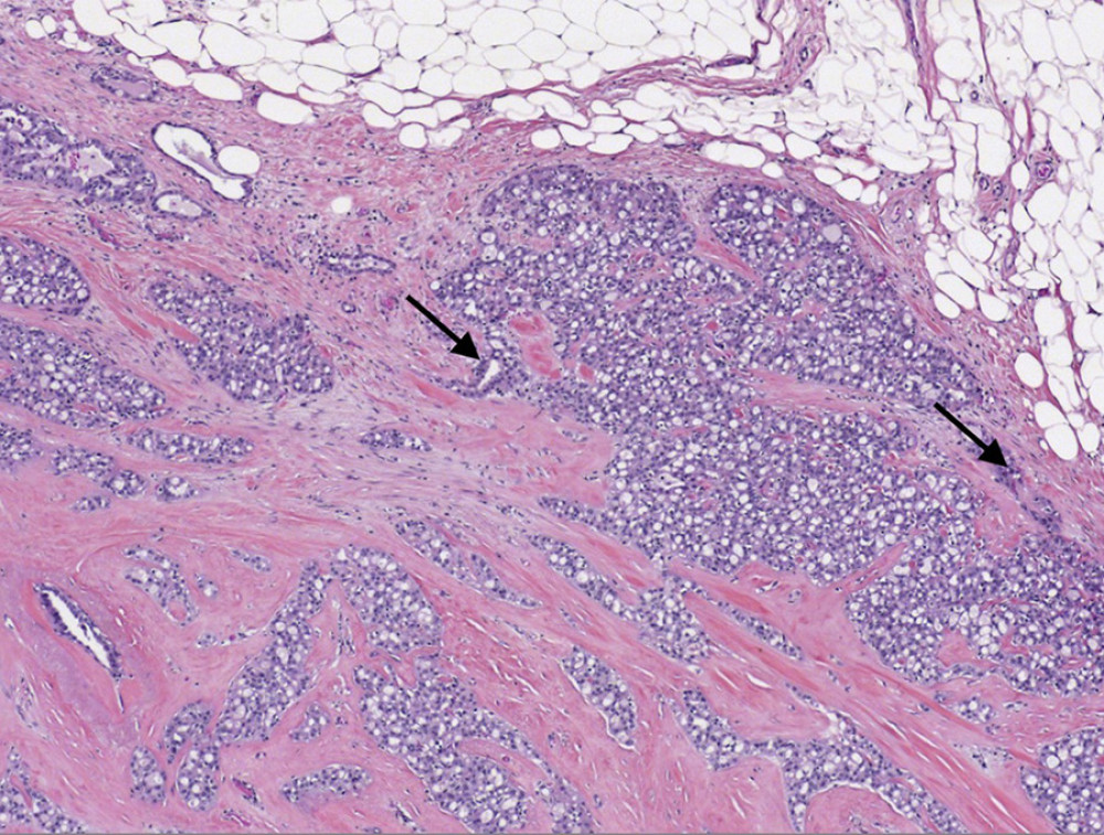 Microscopic examination of the tumor shows tumor cells with predominantly microcystic and tubular patterns (arrows) separated by sclerotic stroma mimicking invasive ductal carcinoma (H&E ×40).