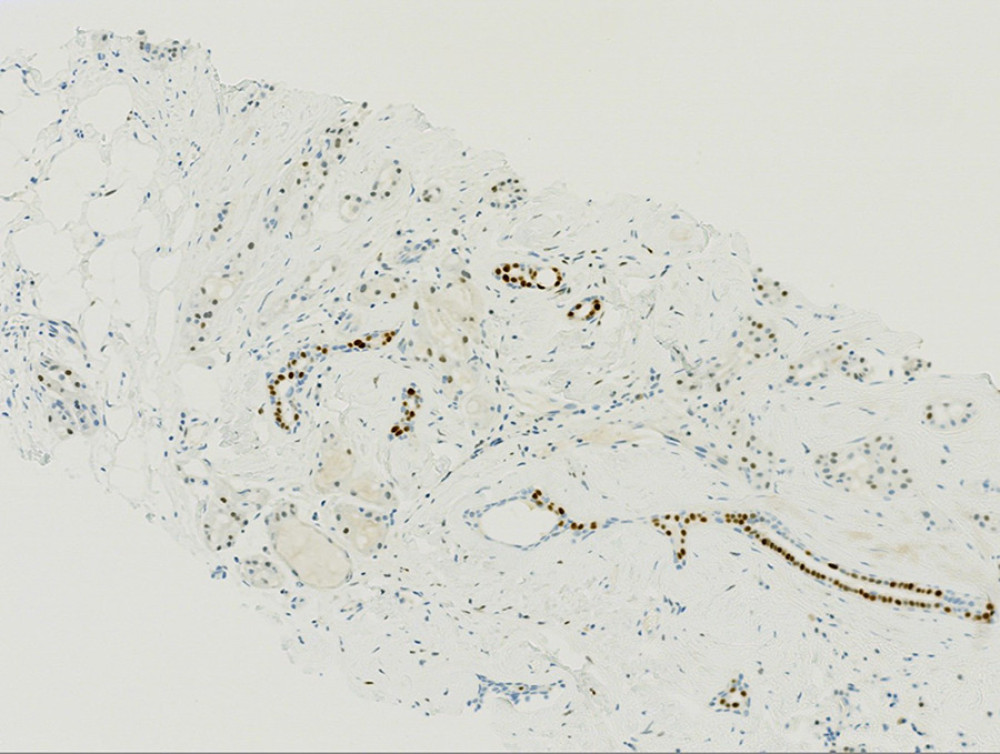 Benign breast ducts at the bottom of the picture show strong positive ER staining, while the tumor cells show weak patchy staining.