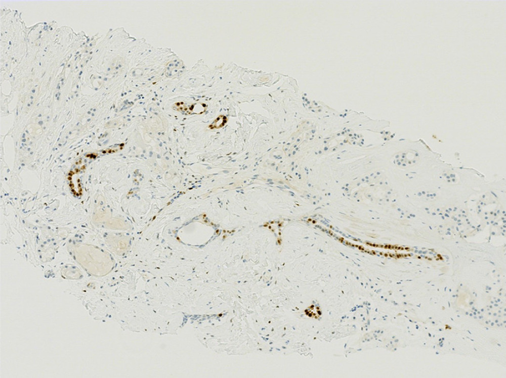 Benign breast ducts at the bottom of the picture show strong positive PR staining, while tumor cells are negative.