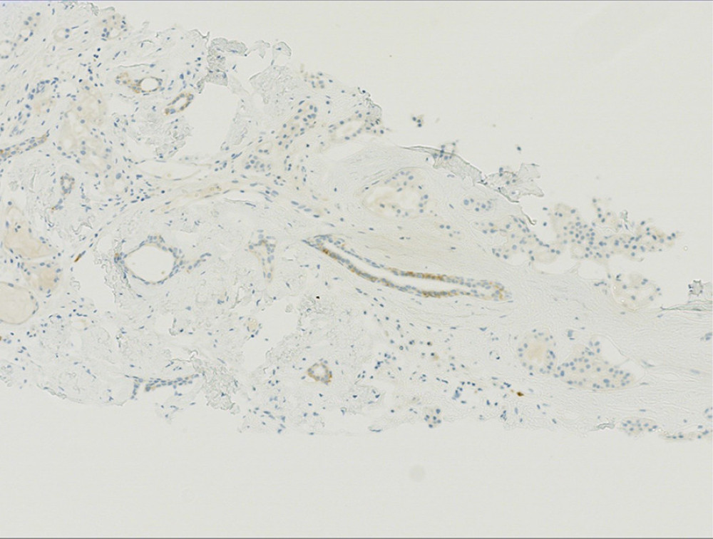 Tumor cells lack membranous HER2/neu staining.