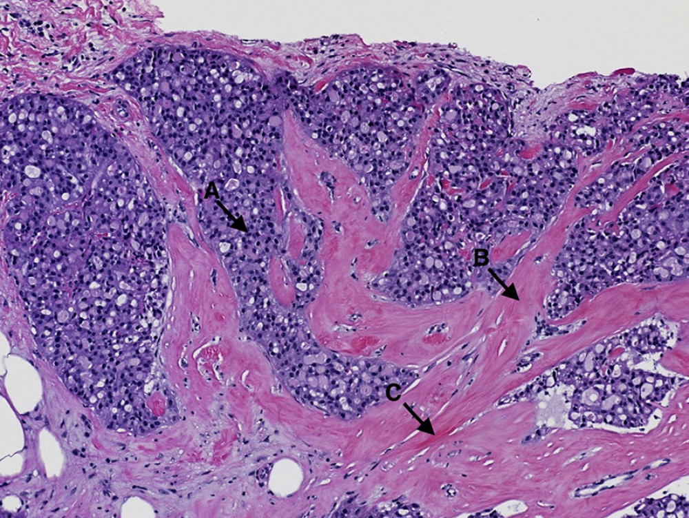 Histopathology of the tumor reveals: A) Tumor cells in nests interpreted as poorly formed tubules. B) Desmoplastic tumor stroma inherent to invasive ductal carcinoma. C) Elastosis involving blood vessels (H&E ×100).