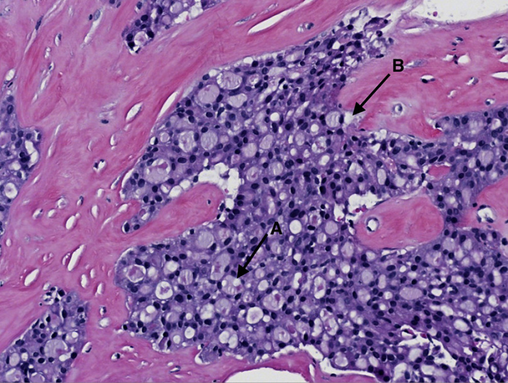 High-power view reveals tumor cells with moderate amounts of foamy vacuolated cytoplasm, uniformed nuclei, minimal mitotic activity, and abundant intracellular A) and extracellular B) secretions (H&E ×200).