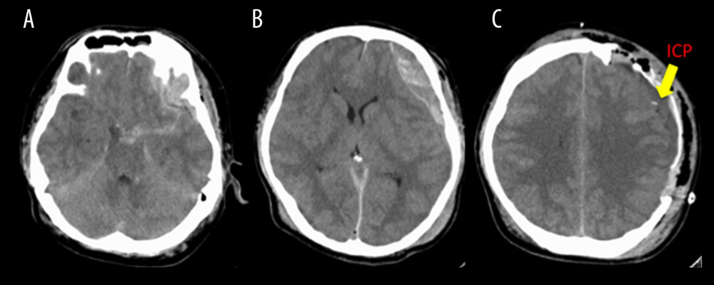 Head computed tomography (CT) before and after emergency craniotomy. (A) On arrival, head CT showed a traumatic subarachnoid hemorrhage (B) as well as a left-sided traumatic epidural hematoma and subdural hematoma. (C) Two hours after the craniotomy, the intracranial hematoma disappeared and an intracranial pressure monitor (ICP, arrow) was inserted. No additional hematoma was seen in the following head CT, which was performed after 7 hours.