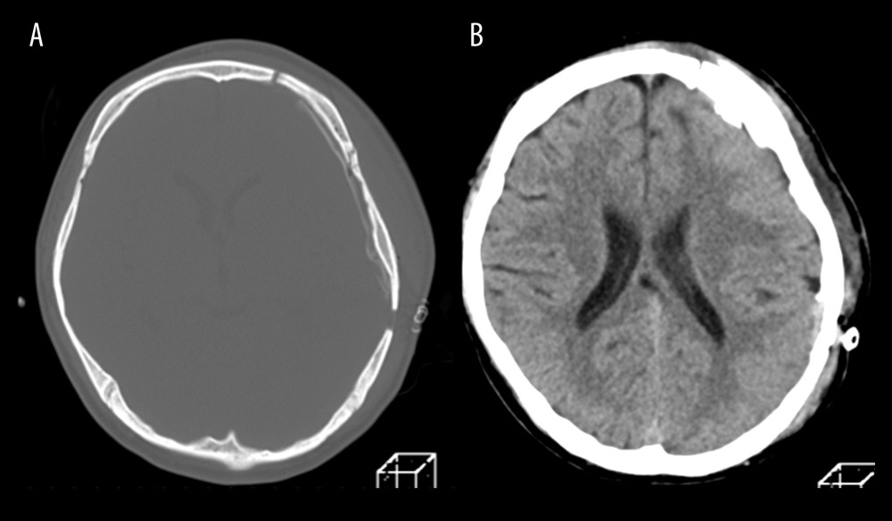 Intraoperative findings during the cranioplasty and computed tomography (CT) after the cranioplasty. (A) The patient’s own bone flap was used for cranioplasty. (B) Head CT showed no intracranial hematoma.