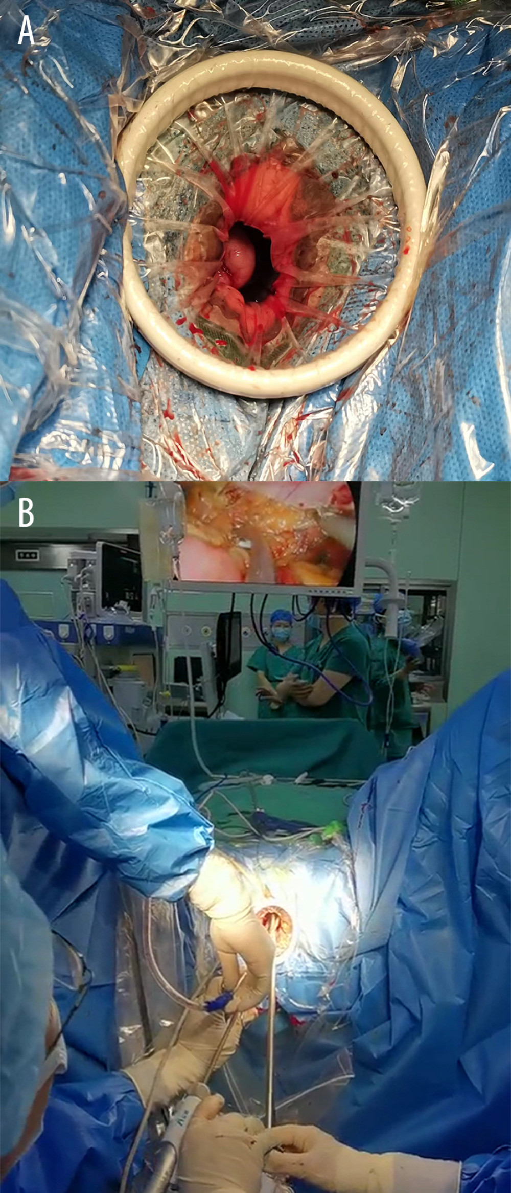 The transvaginal natural orifice transluminal endoscopic surgery (tvNOTES) operating platform. (A) The tvNOTES port was inserted through the vagina into the peritoneal cavity, but the sealing cap of the port was not installed. (B) Instruments were easy to access, and the assistant surgeon could assist the chief surgeon through the port directly. The monitor was placed in front of the chief surgeon.
