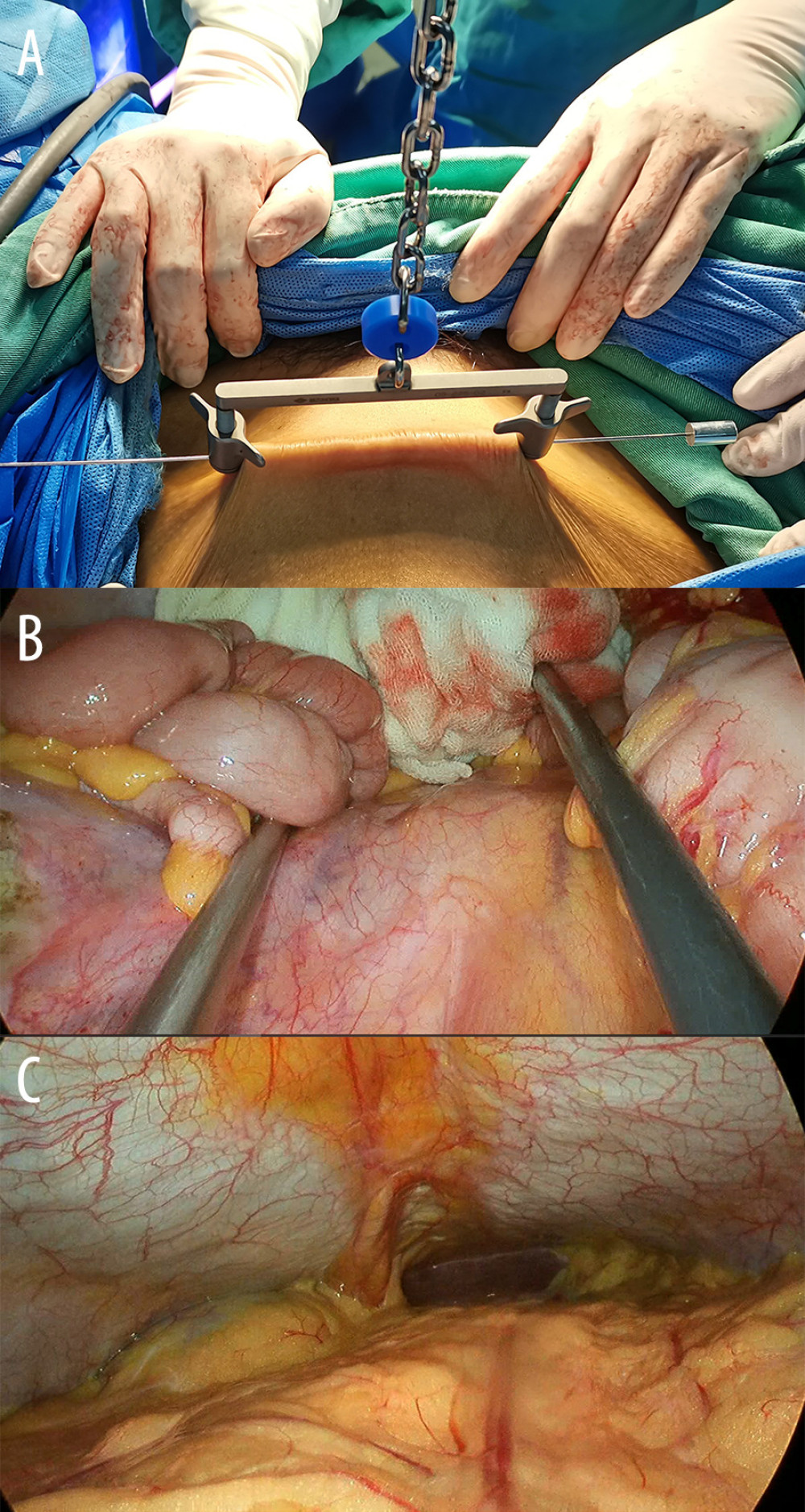 The abdominal wall suspension device setting. (A) The steel needle ran subcutaneously 5 cm above the pubic symphysis, the puncture length was about 10 cm, and both ends were fixed and suspended on the suspensory holder. (B) The pelvis was clearly exposed, and (C) the whole abdominal cavity could be thoroughly explored.