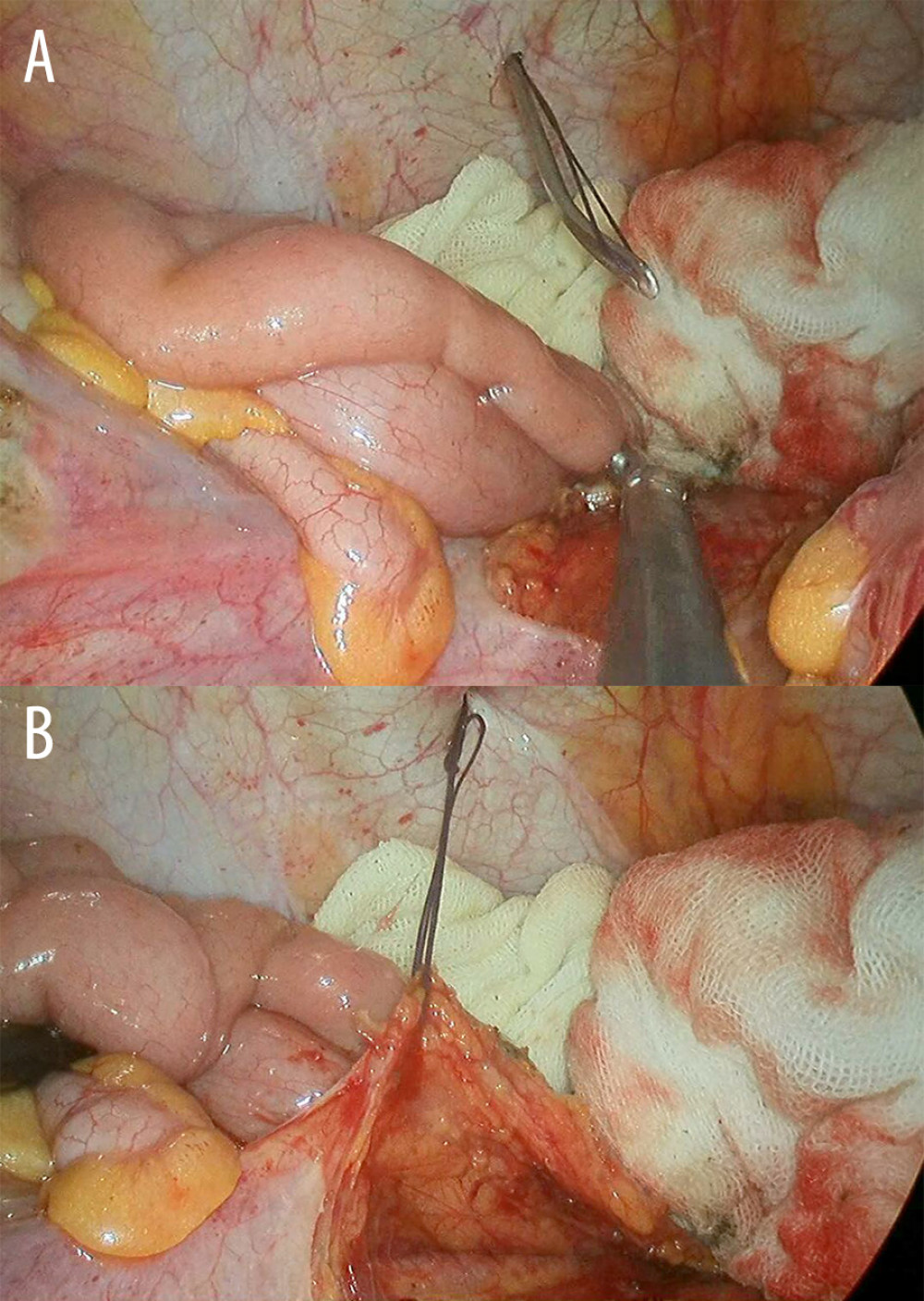 The retroperitoneum suspension needle setting. (A) The needle was passed through the abdominal wall and then to the retroperitoneum. (B) The exposed surgical field after retroperitoneum suspension.