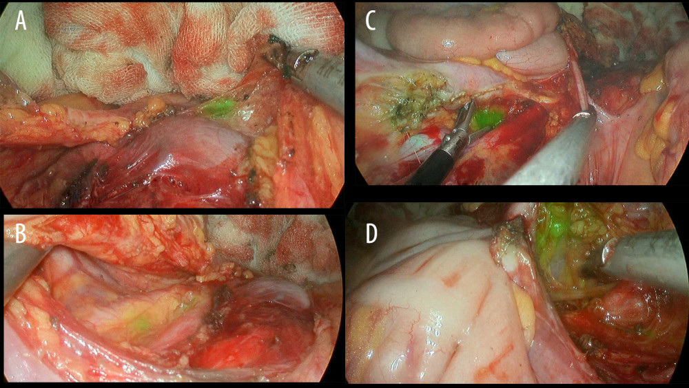 Bilateral pelvic and paraaortic sentinel lymph node (SLN) (shown by white arrow). (A–D) The SLN could be exposed and dissected.