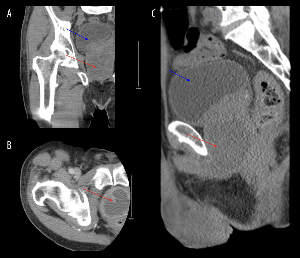 Contrast computed tomography (CT) of the right hip with coronal (A), axial (B) and sagittal views (C) showing a 4.0×4.9 cm peripherally enhanced fluid collection within the prostate, suspicious for an abscess (see red arrow), along withbladder distension (see blue arrow).