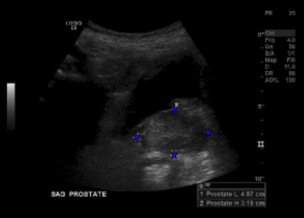 Post-drainage pelvic ultrasound shows a severely enlarged prostate (volume 40cc) without fluid collection (see blue arrows).
