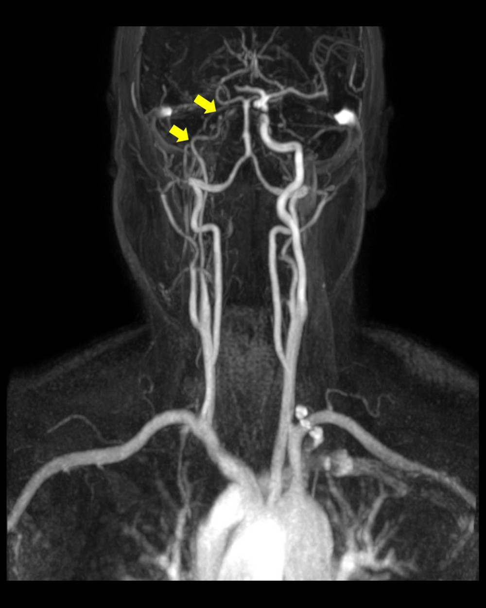 The brain magnetic resonance angiography shows stenosis of the right internal carotid artery with occlusion from the cavernous segment.