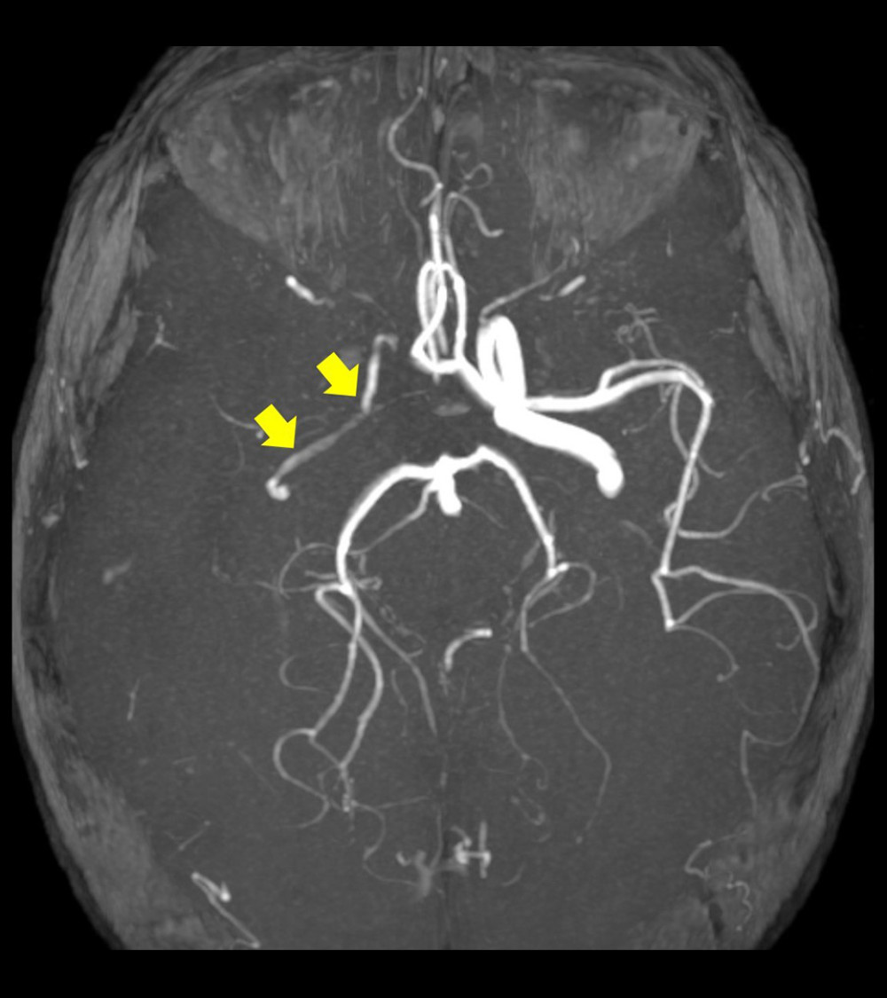 The brain magnetic resonance angiography shows stenosis of the right middle cerebral artery with filiform flow.