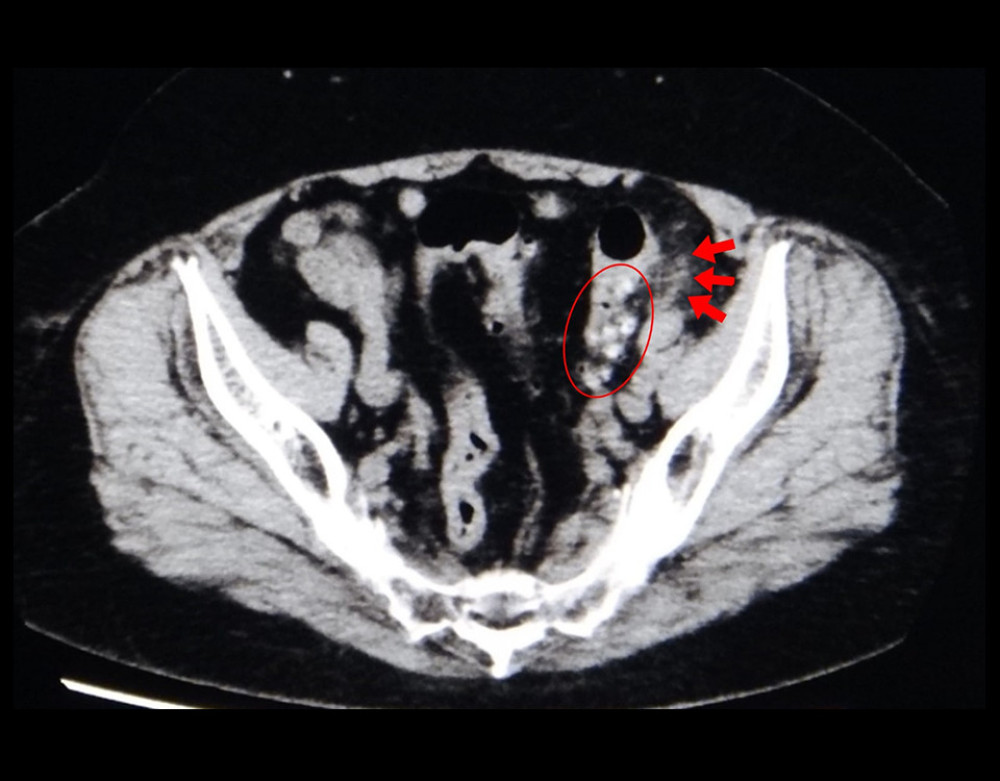 Plain computed tomography findings on the first visit. The scan shows inflammation around diverticula in the sigmoid colon. The diverticula are circled and its inflammation is indicated with arrows.