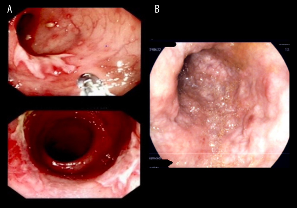 (A, B) Colonoscopy showing multiple ulcers with exudations.