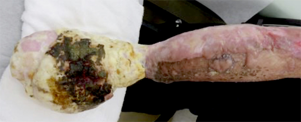 The scarred tissue before surgery.