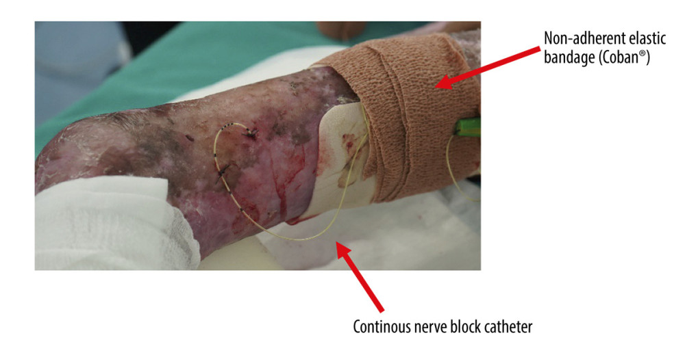 Fixed continuous sciatic nerve block catheter. Red arrows indicate non-adherent elastic bandage and continuous nerve block catheter.