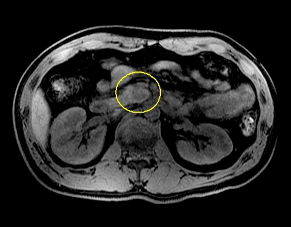 Abdominal diffusion-weighted magnetic resonance imaging showed relatively strong enhancement effect from the early phase at the pancreatic uncinate process.