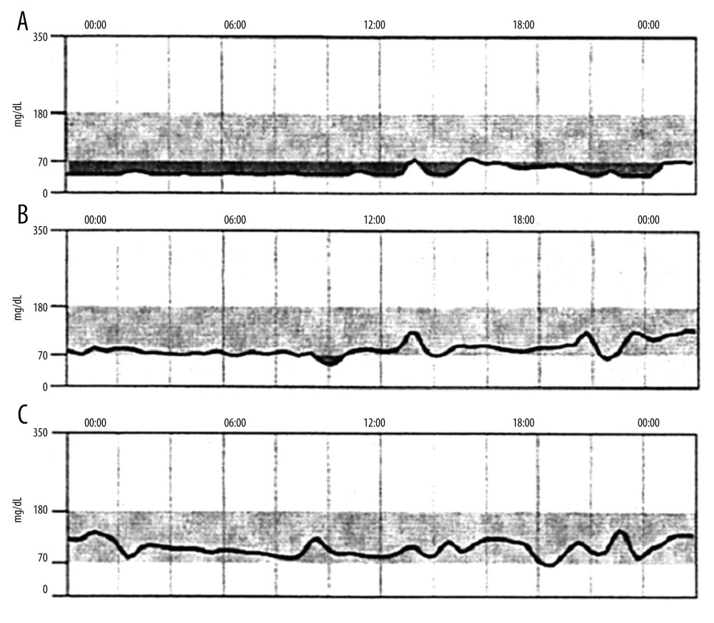 Results of Freestyle Libre Pro continuous glucose monitoring before and after diazoxide administration. (A) Before, (B) 2 days after, and (C) 4 days after. Before starting diazoxide, hypoglycemia appeared throughout the day. Diazoxide was started at 75 mg/day (1.05 mg/kg), with mild improvement and no observed adverse effects.