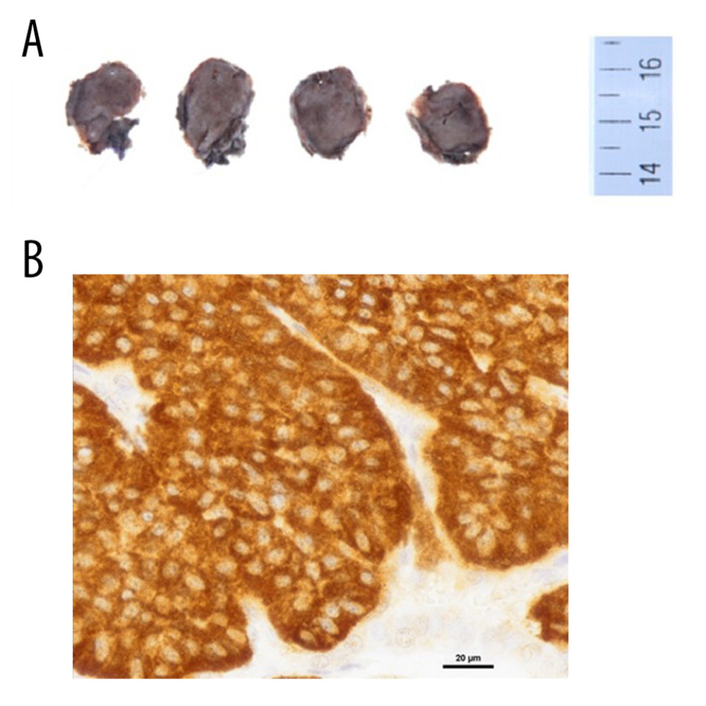 Histological and immunohistological findings of tumors in the pancreatic uncinate process. (A) Surgical specimen of pancreas: gross classification was nodule type, and tumor diameter was 19×17×16 mm. (B) Histopathology: pancreatic tumor cells with Ki-67 percentage of 3% of synaptophysin (synaptophysin staining, ×200).