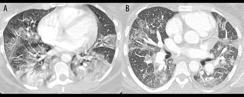 Chest CT of Case 2 performed on admission (A) and of Case 3 performed on hospital day 5 (B).