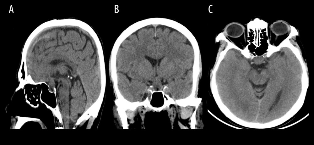CT scan brain plain. (A) Sagittal view showing large sellar lesion causing erosions of the sellar floor. (B) Coronal view showing a heterogenous density lesion of the sellar region. (C) Axial view showing a sellar mass compressing the optic chiasma.