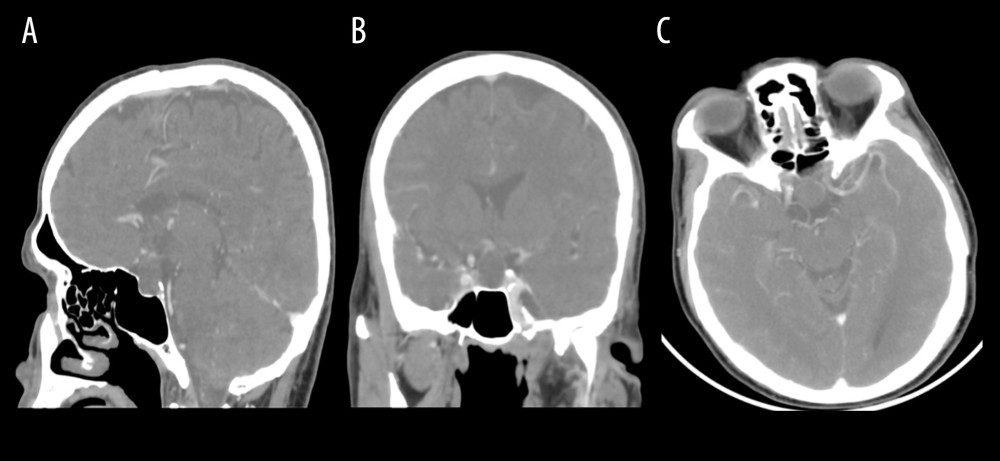 CT scan brain with contrast. (A) Sagittal view showing a large sellar lesion. (B) Coronal view showing a hypodense lesion with minimal peripheral enhancement. (C) Axial view showing a well-defined sellar mass with ring enhancement.