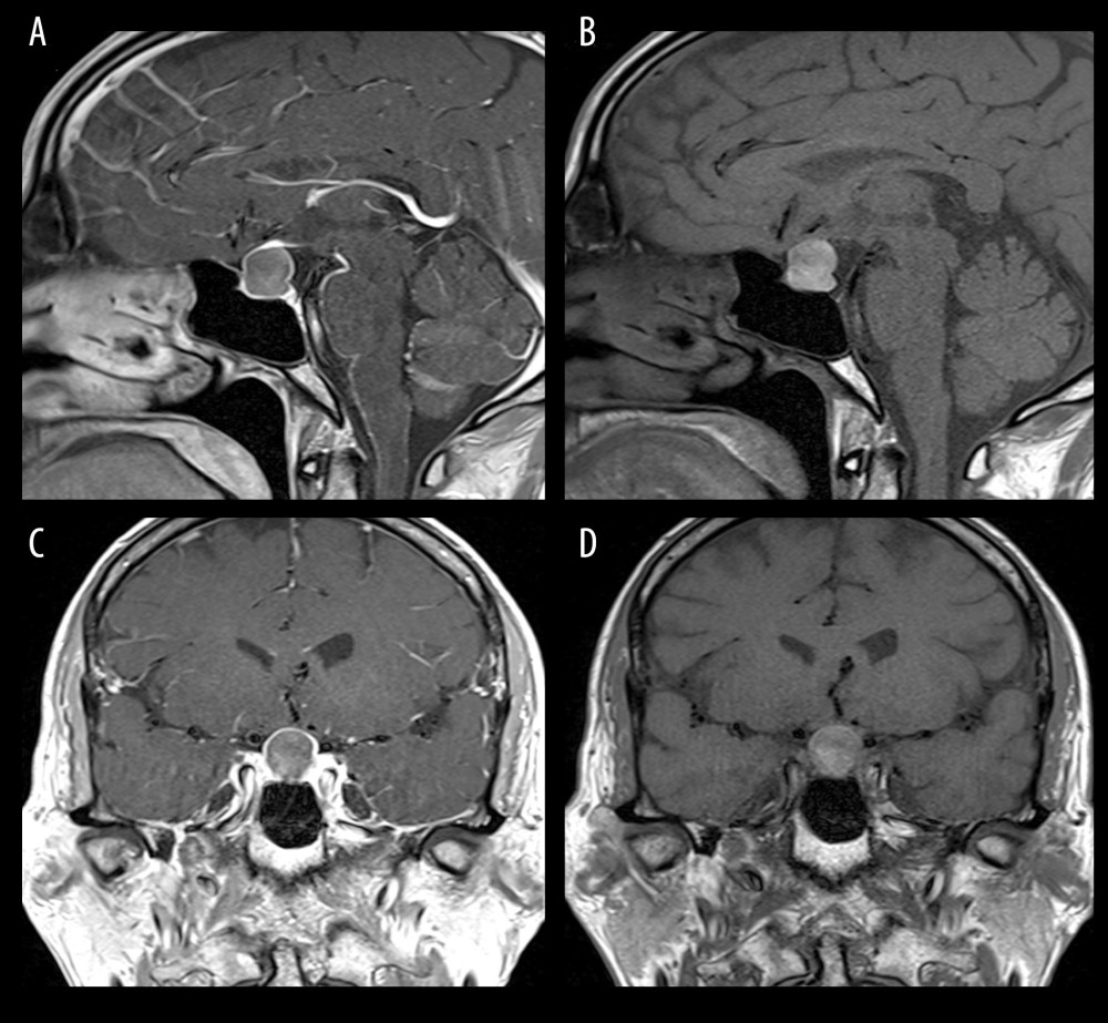 MRI images w/wo contrast. (A) MRI T1 with contrast image sagittal view showing sellar heterogeneously iso-hyperintense lesion with ring enhancement. (B) MRI T1 without contrast sagittal view showing a sellar heterogeneously iso-hyperintense mass compressing the optic chiasma superiorly. (C, D) Coronal views w/wo contrast showing well-defined border pituitary lesion with heterogenous intensities. The lesion is causing a mass effect superiorly on the third ventricle, but is not invading the cavernous sinuses bilaterally.