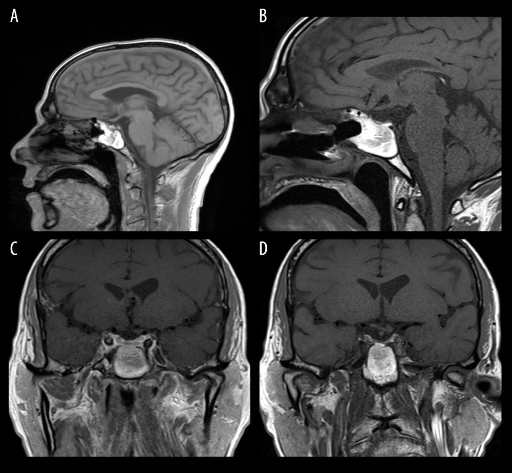 Postoperative MRI plain (A, B: sagittal views, C, D: coronal views) showing complete drainage of the pituitary abscess and resolution of the mass effect with postoperative changes in the sphenoid sinuses bilaterally.