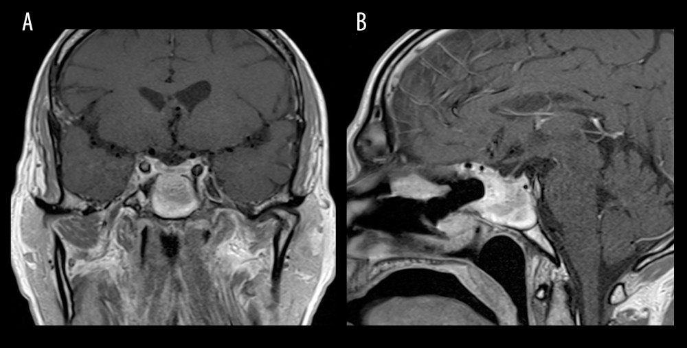 Postoperative MRI with contrast. (A) Coronal view showing complete resolution of the pituitary abscess. (B) Sagittal view showing complete drainage of the pituitary abscess, with the enhancement of the sphenoid sinus due to postoperative changes.