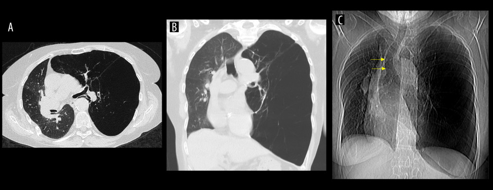 (A) Preoperative axial chest computed tomography scan. (B) Preoperative coronal chest computed tomography scan. (C) Preoperative plain chest radiography illustrating rightward mediastinal deviation and compression of the grafted lung; arrows pointing at the border of the trachea showing right deviation.