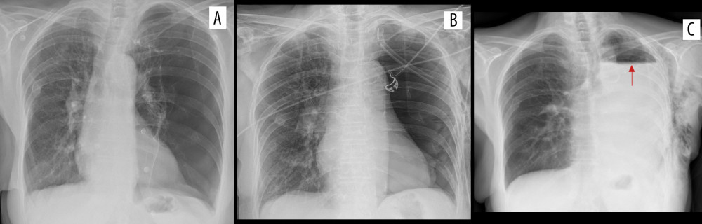 Antero-posterior chest radiographs: (A) Before surgery. (B) 2 hours after extubating the patient. (C) Ten hours postoperatively showing fluid accumulation in the left pleural cavity; red arrow pointing at the upper limit of the fluid level.