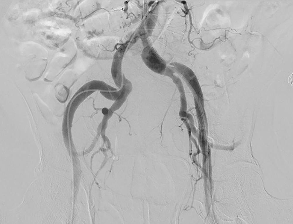 Iliofemoral arteriogram demonstrates extreme tortuosity of the patient’s vasculature.