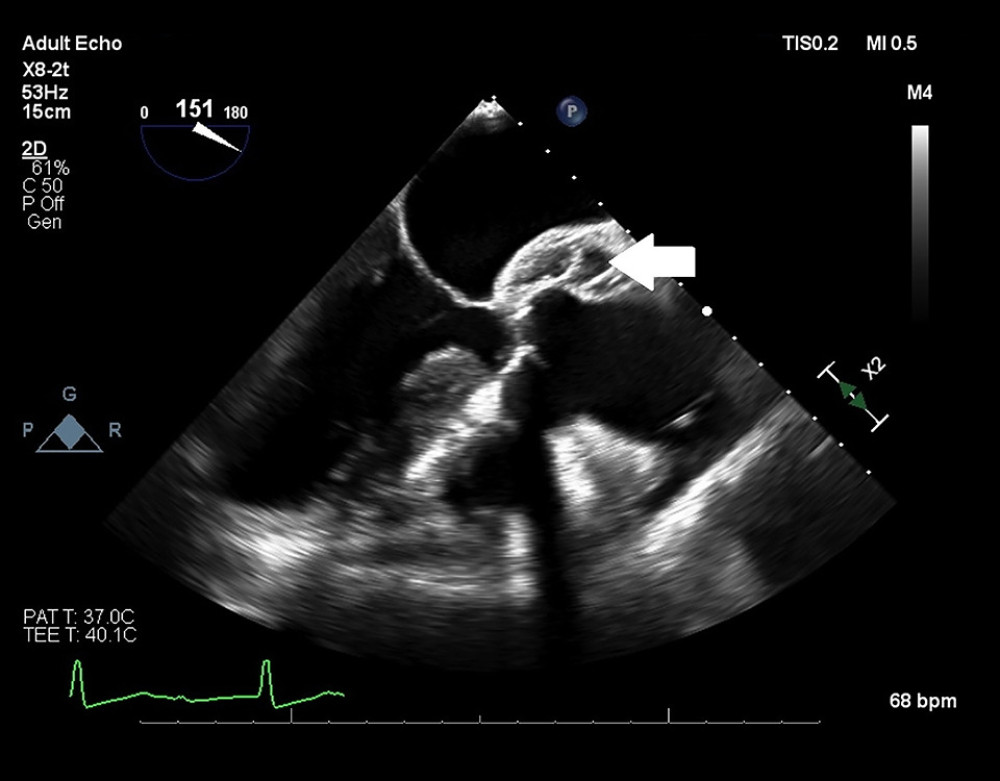 Periaortic hematoma located at the aortic root. The hematoma was noted after many unsuccessful attempts to access the left ventricular outflow tract with wires and catheters via the ascending aorta and prior to balloon valvuloplasty.