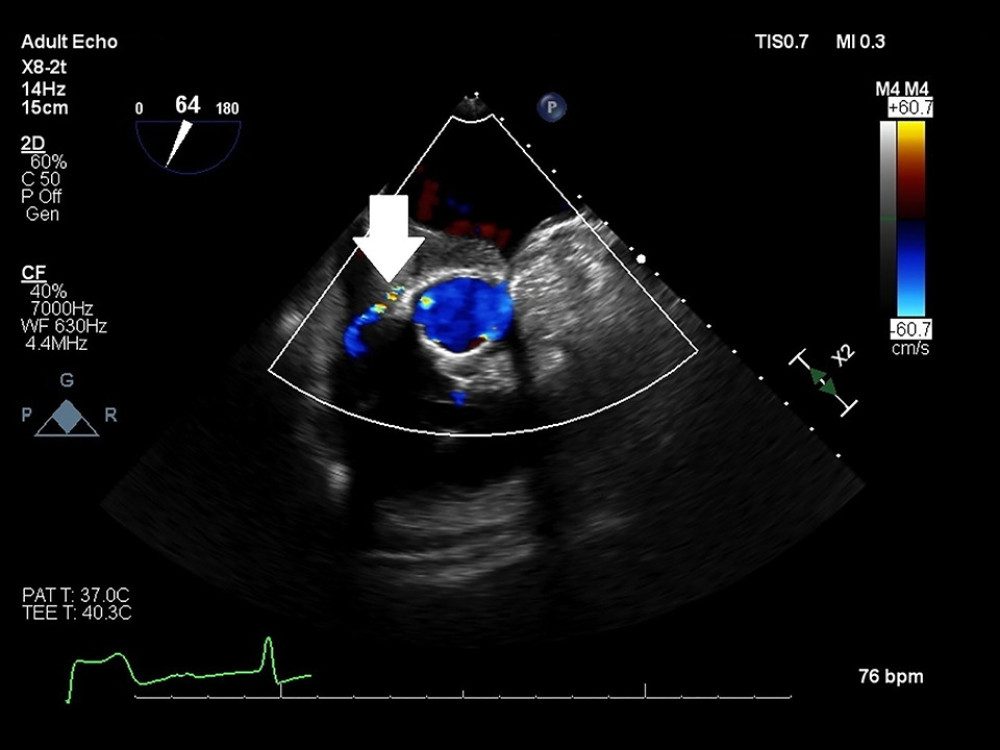 Color flow Doppler demonstrating the angulated course of the aorto-atrial fistula.