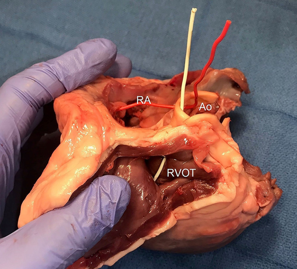 Pig heart dissection demonstrating the differences in course of wires from the aorta to the right ventricle (white wire) and the aorta to the right atrium (red wire). The pig heart was obtained from a local butcher.