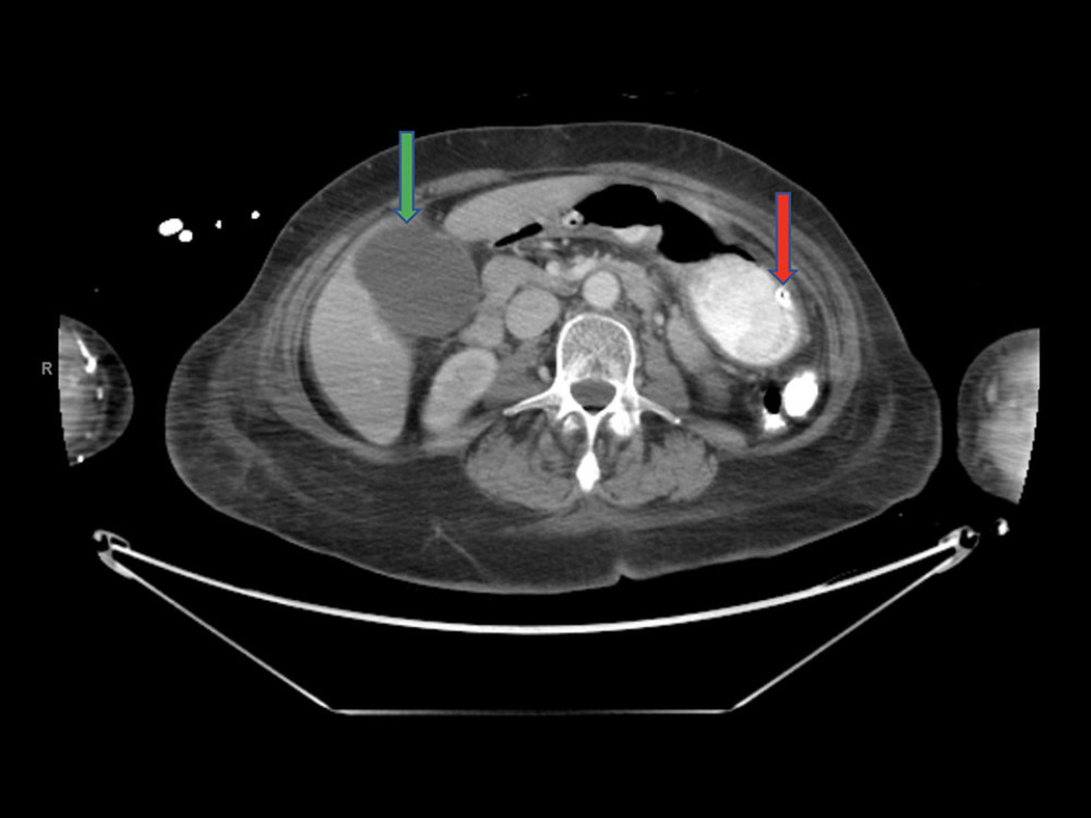 CT abdomen and pelvis with i.v. contrast and oral Gastrografin (GE Lightspeed RT 16). A CT obtained on day 3 of hospitalization demonstrated a nasogastric tube with its tip in the stomach (red arrow), moderately distended gallbladder with mild biliary ductal distention (green arrow), and no bezoar identified.