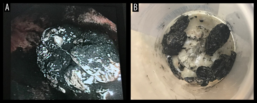 (A) Gastric contents during endoscopy. (B) Packet/paper with pills retrieved by endoscopy.